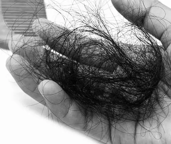 Injerto de pelo con trasplante de pelo para crecer, Madrid, España